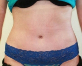Feel Beautiful - Tummy Tuck Case 25 - After Photo